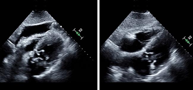 Women Have Higher Risk of TAVR-Related Pericardial Complications